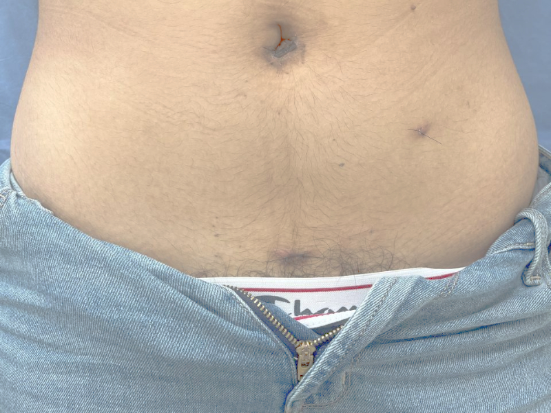 laparoscopia en veracruz1